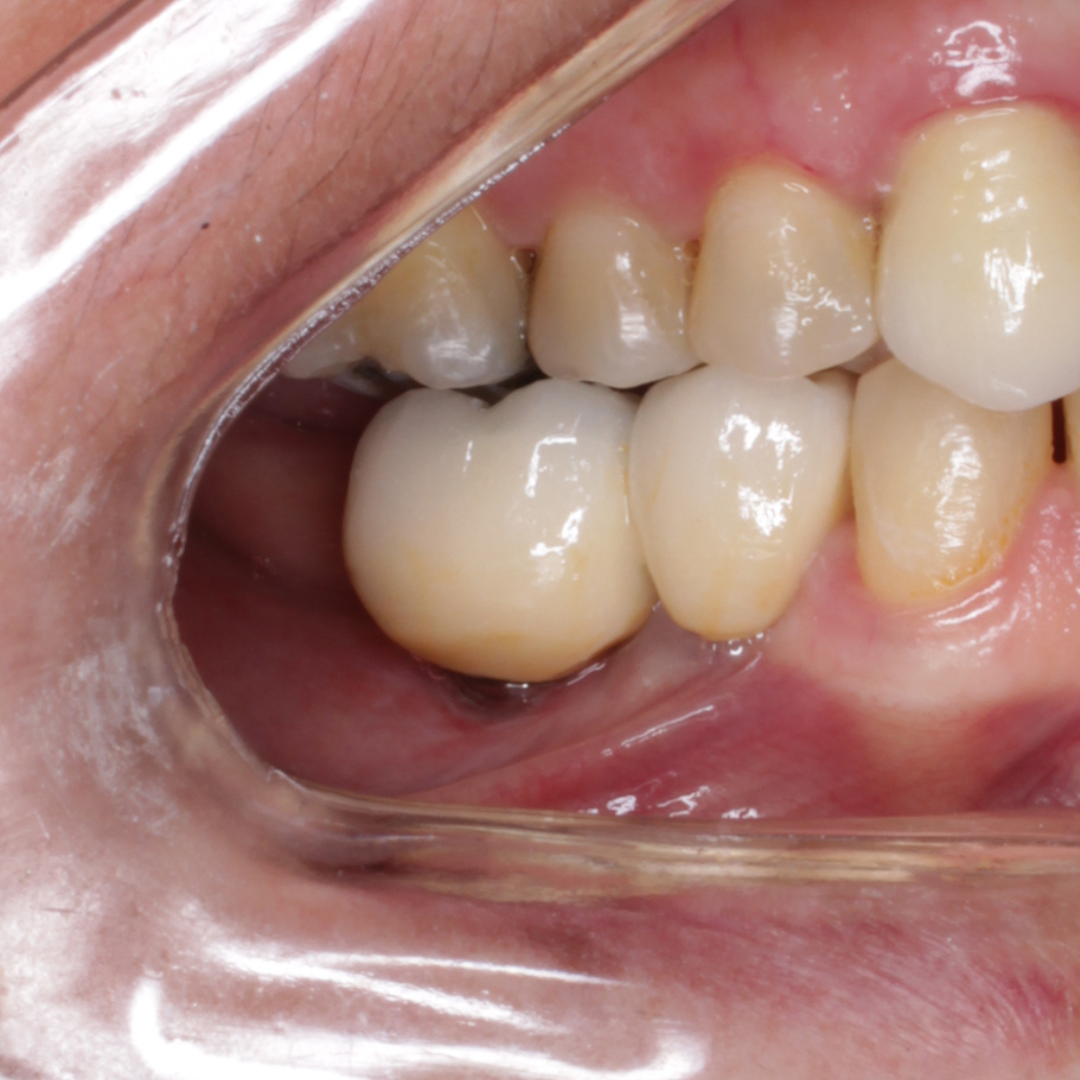 Depois — Implante Dentário