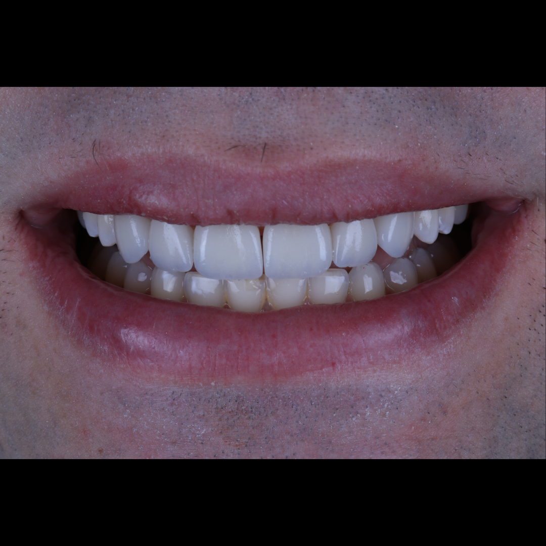 Depois — Lentes em Porcelana