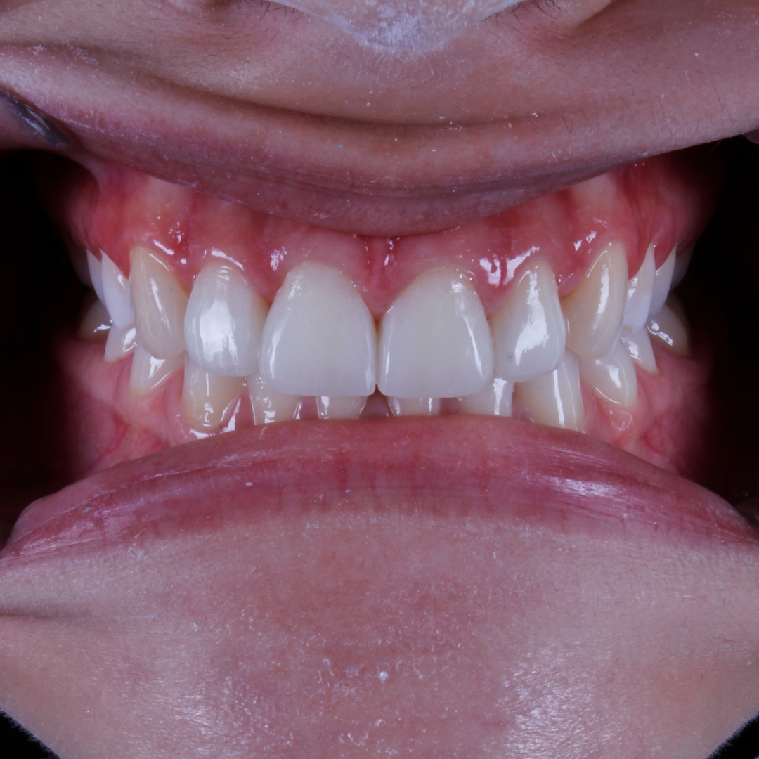 Depois — Facetas em Resina