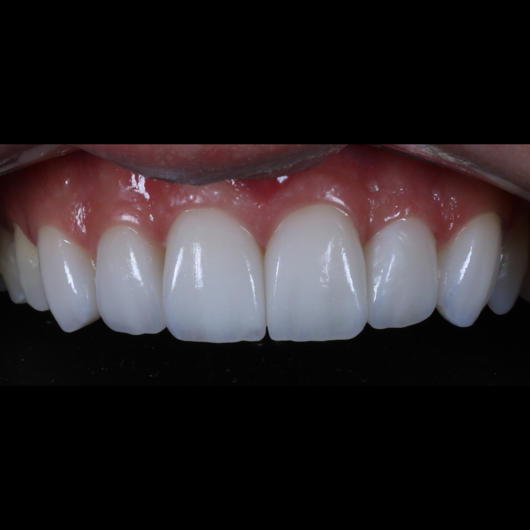 Depois — Lentes em Porcelana