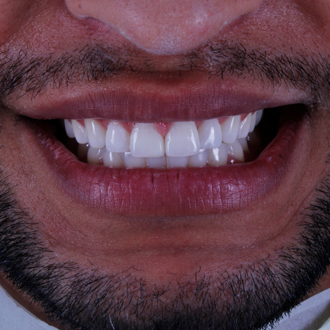 Depois — Facetas em Resina