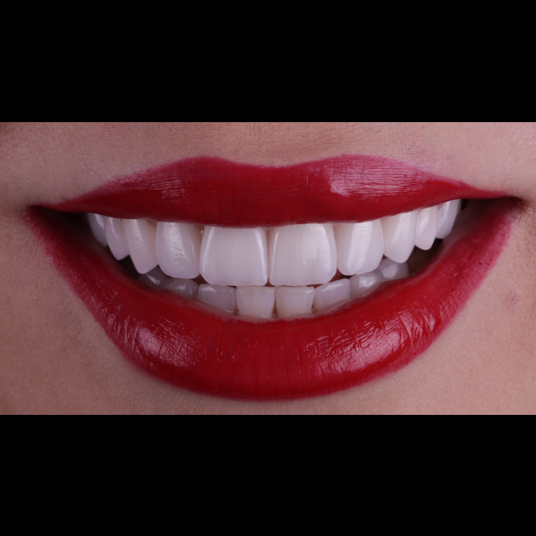Depois — Lentes em Porcelana